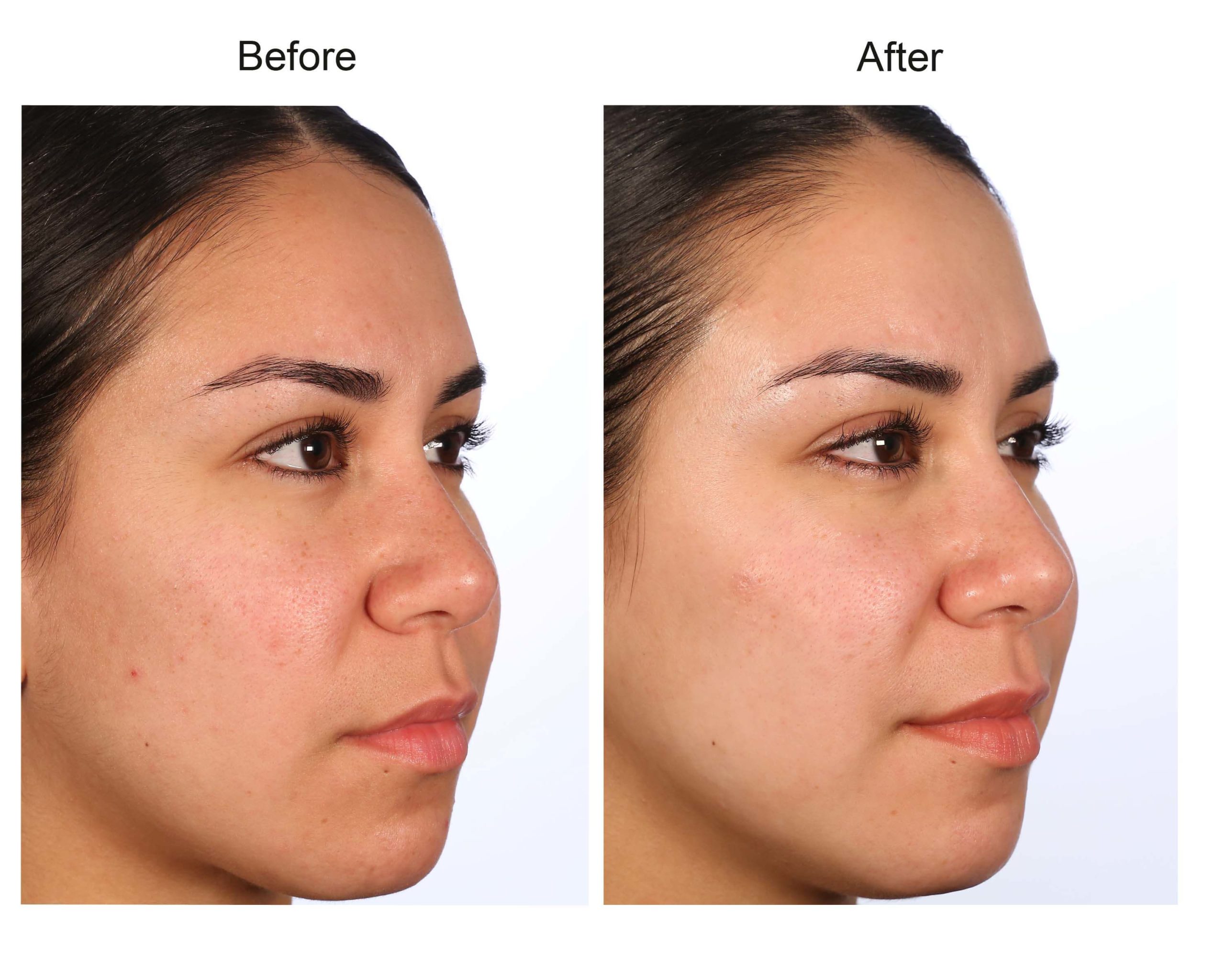 Refresh Skin Therapy – Professional Peels, Powerful Skin Solutions