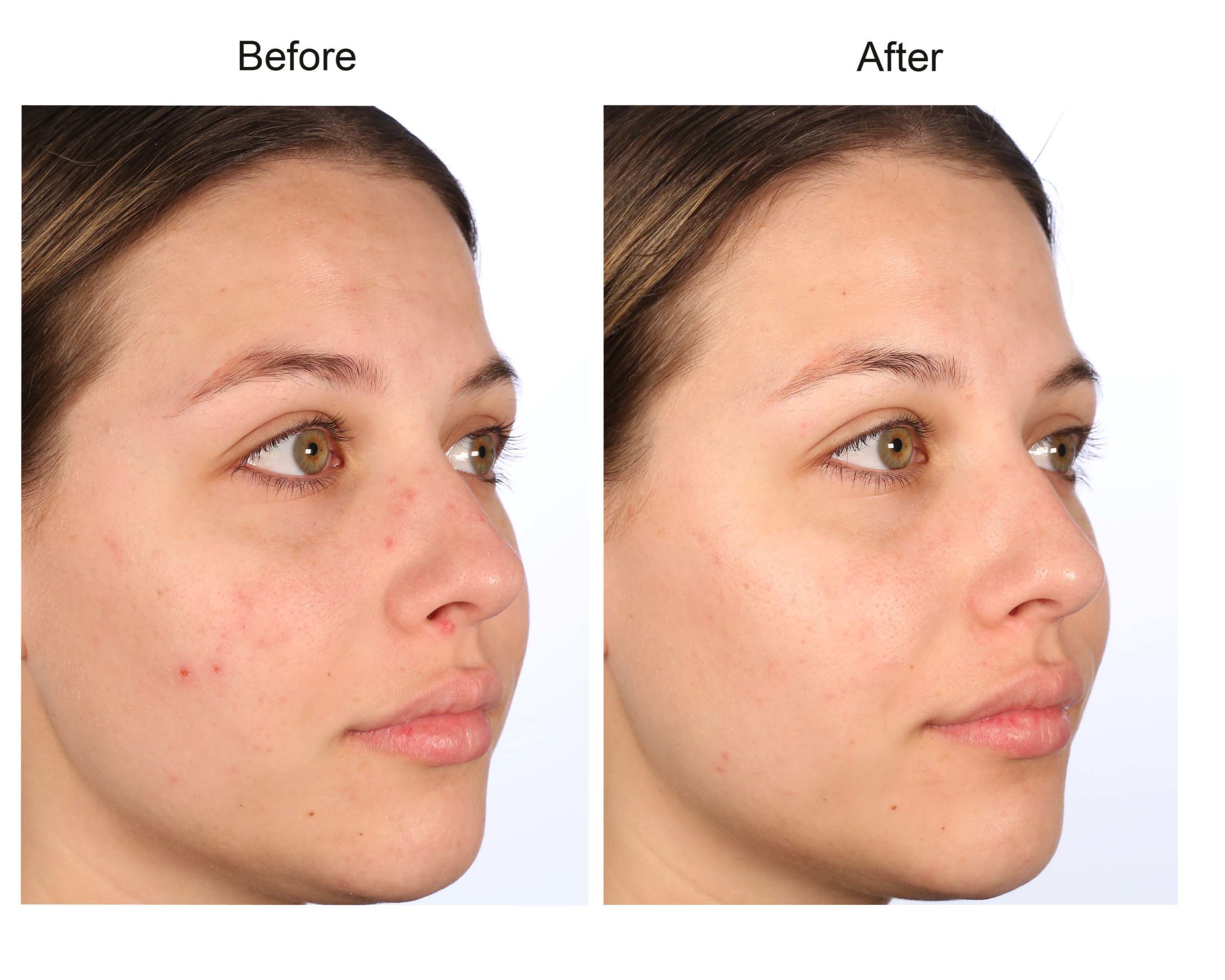 Refresh Skin Therapy – Professional Peels, Powerful Skin Solutions